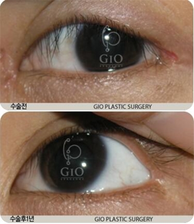 韩国GIO外眼角疤痕修复前后照片