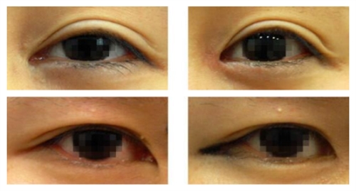 韩国gio和eve修复眼角手术谁做的更厉害？
