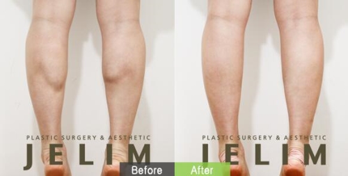 韩国JELIM医院小腿消除手术前后对比照片