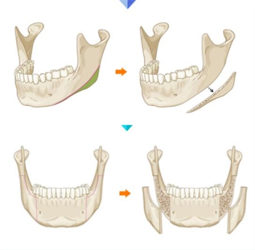 韩国布拉德下颌角整形手术方法示意