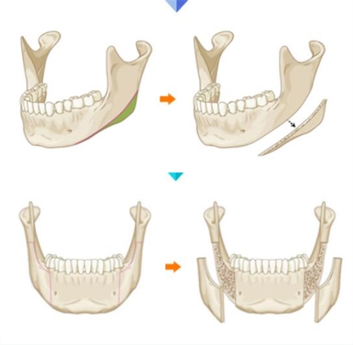 韓國布拉德下頜角整形手術(shù)方法示意