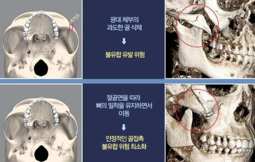 韩国布拉德整形石润特色日记公开，小脸术原来真存在！