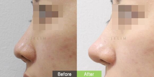 韩国JELIM医院短鼻矫正前后对比照片