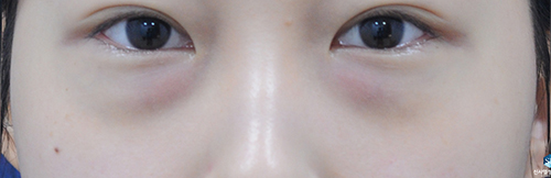 韩国SL整形医院祛黑眼圈真人日记对比