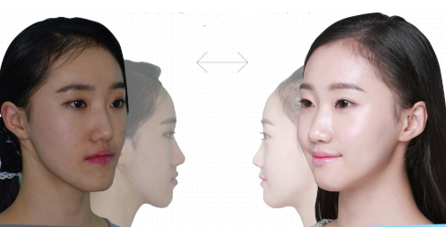 韩国齐娥整形外科轮廓整形对比案例