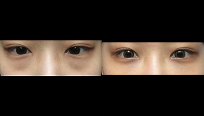 韩国新沙L整形医院黑眼圈案例对比