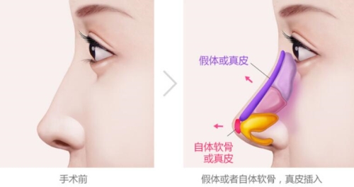 韩国普瑞美隆鼻手术方法