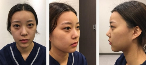 韩国普瑞美面部填充+鼻部矫正术前照片