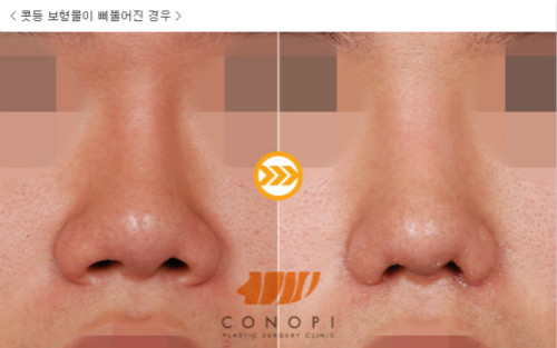 韩国高诺鼻隆鼻医院位置在哪？做修复找它还是nano？