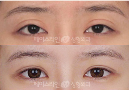 推荐几个韩国眼部整形医院，擅长双眼皮修复开眼角修复