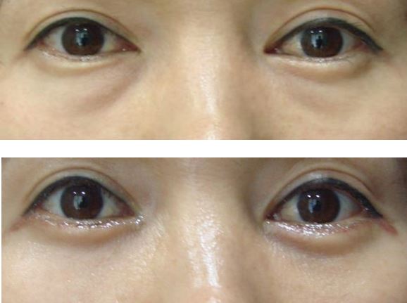 推荐几个韩国眼部整形医院，擅长双眼皮修复开眼角修复