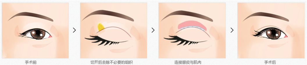 韩国切开法双眼皮手术过程示意图