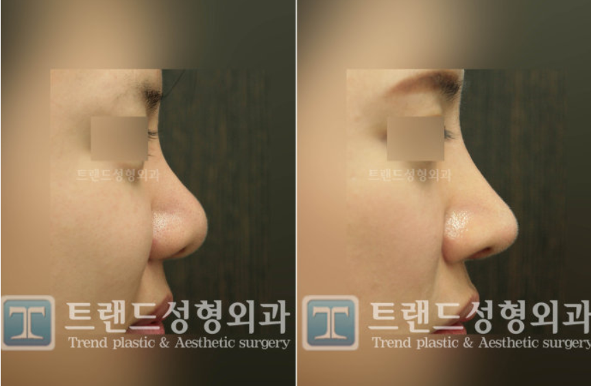 韩国trend整形外科隆鼻案例