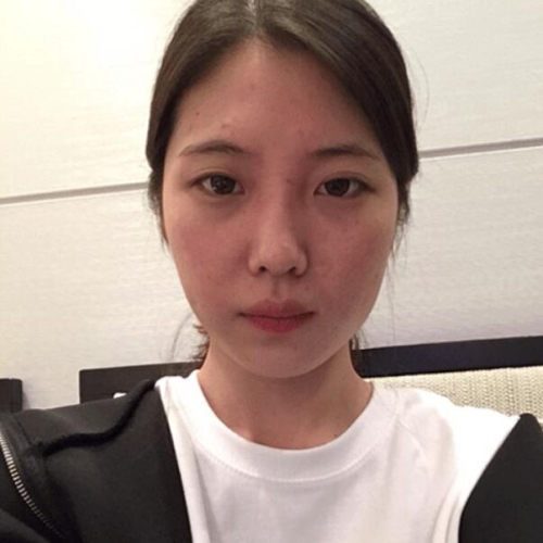 韩国美可整形李圣俊眼鼻面部填充术前照片