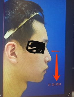 韩国SL男士鼻部整形案例