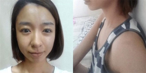 韩国美可面部填充+胸部整形术前照片