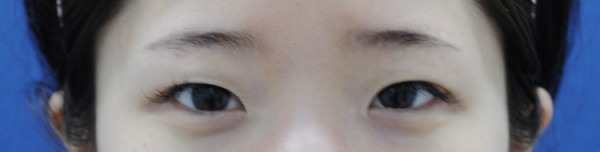 韩国新沙L双眼皮手术日记