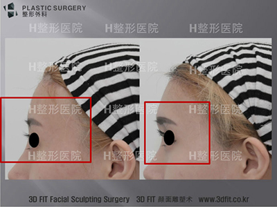 韩国h整形医院额头+眉弓整形对比
