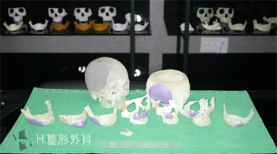 韩国h白汀恒整形医院3D骨骼打印技术