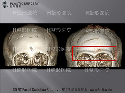 韩国h整形3d骨骼打印技术CT照片