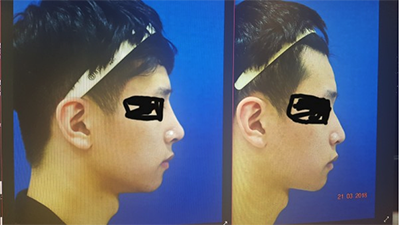 韩国新沙L整形医院隆鼻手术案例