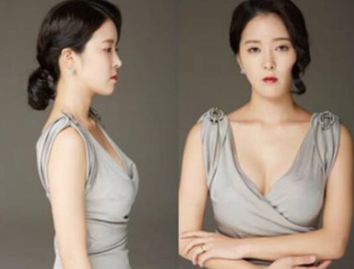 韩国美可水滴形胸部整形术后照片