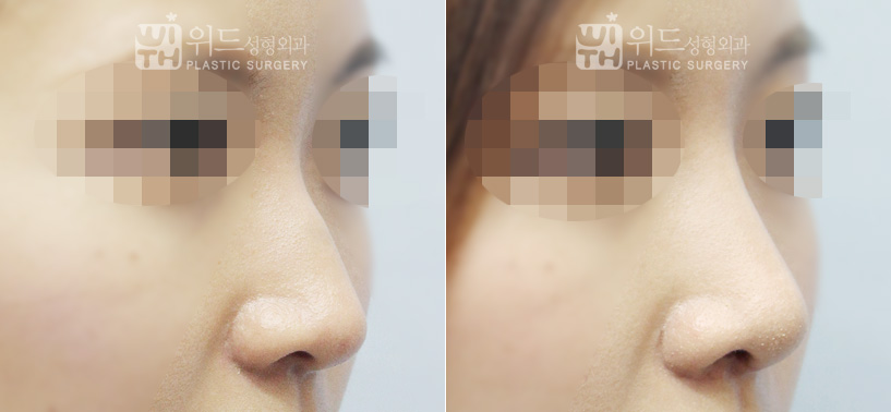 韩国维德驼峰鼻整形案例3个月恢复对比图