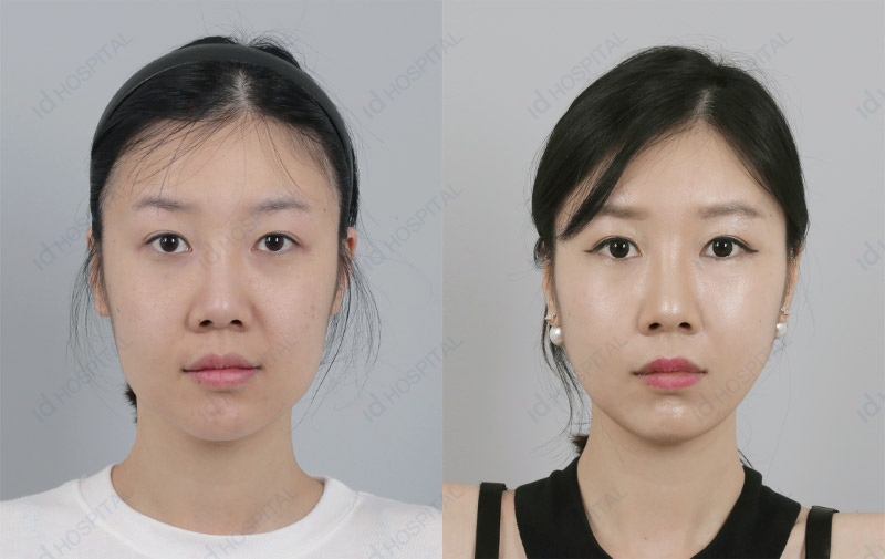 韩国ID面部提升对比案例
