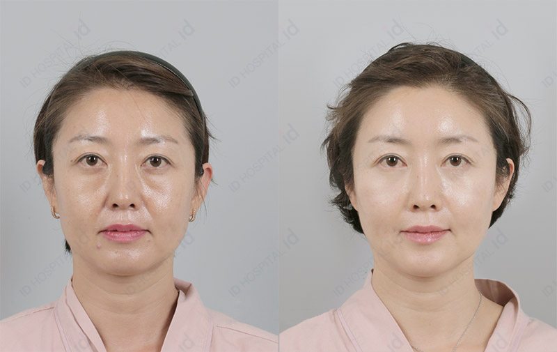 韩国ID微创提升术案例