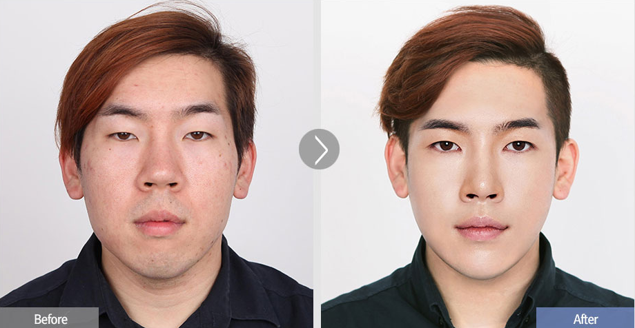 韩国菲斯莱茵整形外科男性下颌角整形案例