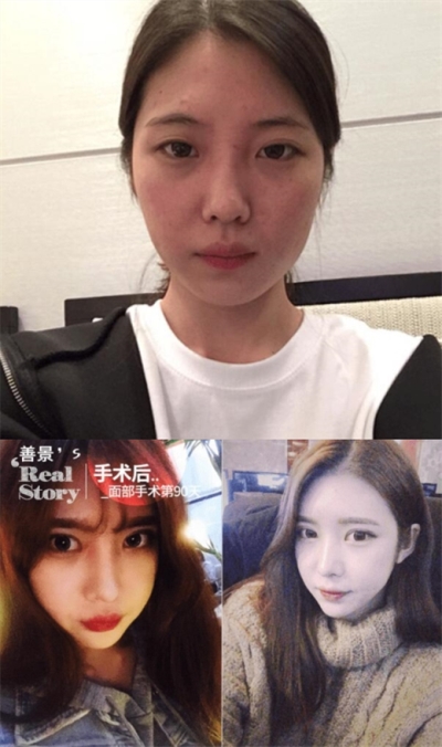 韩国美可整形眼鼻面部填充术前后照片
