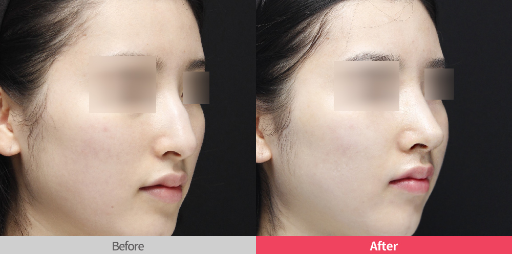 韩国丽丝塔整形外科驼峰鼻案例