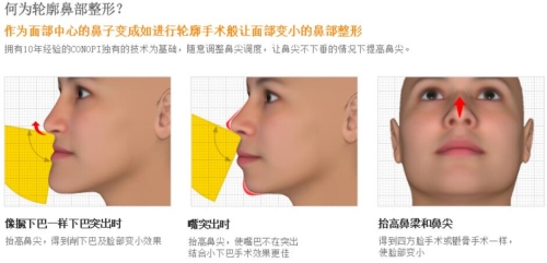 韩国高诺鼻conopi轮廓鼻整形方法