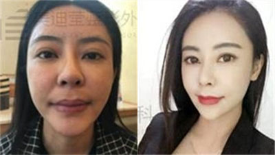 韩国美迪莹面部吸脂+提拉手术对比