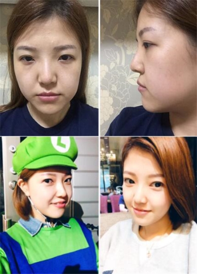 韩国加美眼鼻整形术后3个月恢复照片