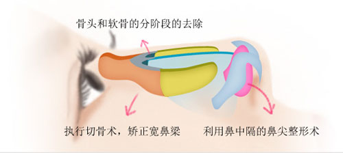 驼峰鼻矫正手术过程