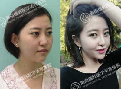 海南瑞韩医美假体隆鼻前后对比照片