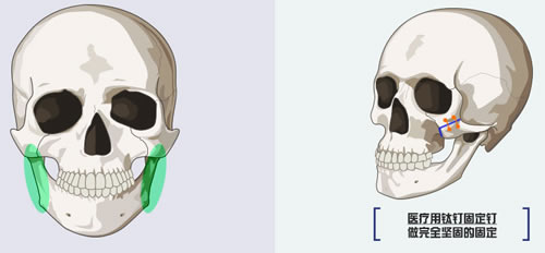 韩国dr朵整形外科3D均衡颧骨术