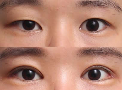 双眼皮+开眼角手术对比日记