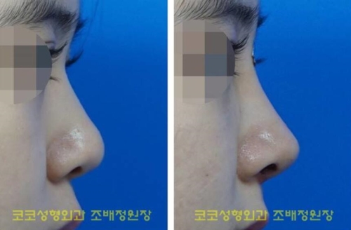 韩国Koko短鼻矫正前后对比照片