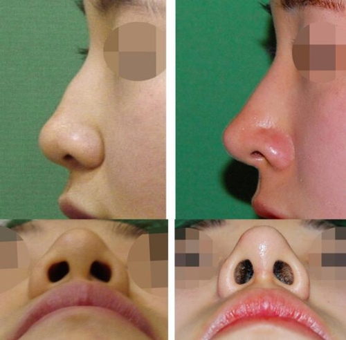韩国KOKO整形医院驼峰鼻矫正手术前后照片