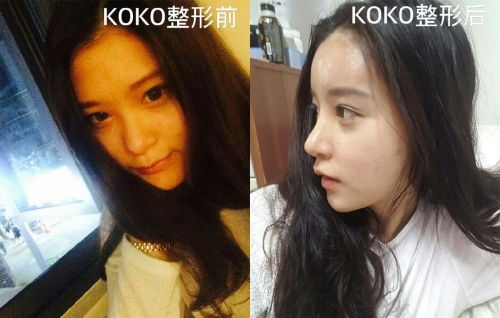 韩国Koko整形福鼻矫正前后对比照片