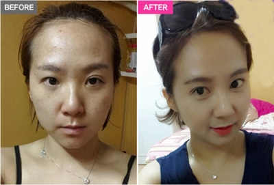 韩国A特整形医院双眼皮修复手术对比照片