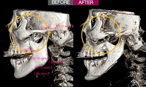 一路美整形外科颧骨术后CT照