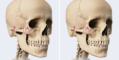 GNG整形外科颧骨固定特点分析