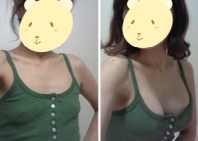 韩国A特整形医院隆胸手术前后照片对比