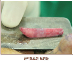 肋软骨隆鼻在韩国多用在修复，这些真相内幕你知道多少？