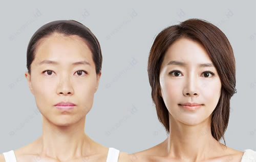韩国ID整形外科额头填充真人案例