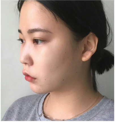 韩国thenan整形外科鼻整形案例