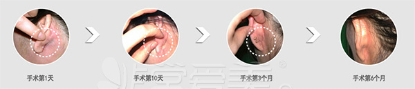 韩国伍人整形下颌角手术方法